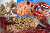 Đừng chủ quan, đau lưng âm ỉ cũng có thể tiểu ra sỏi Đừng chủ quan, đau lưng âm ỉ cũng có thể tiểu ra sỏi