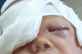 Chó nhà nuôi lao vào cắn xé khiến bé 20 tháng tuổi rách nát đầu mặt Chó nhà nuôi lao vào cắn xé khiến bé 20 tháng tuổi rách nát đầu mặt