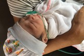 Yên Bái: Gia đình choáng váng khi bé sơ sinh vừa chào đời đã gãy xương đòn Yên Bái: Gia đình choáng váng khi bé sơ sinh vừa chào đời đã gãy xương đòn
