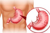 Bé trai 7 tuổi chảy máu dạ dày sau khi ăn món ăn mùa hè đứa trẻ nào cũng thích Bé trai 7 tuổi chảy máu dạ dày sau khi ăn món ăn mùa hè đứa trẻ nào cũng thích