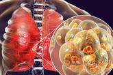 4 dấu hiệu cảnh báo căn bệnh ung thư phổi đang tấn công cơ thể, đừng coi thường kẻo mất mạng 4 dấu hiệu cảnh báo căn bệnh ung thư phổi đang tấn công cơ thể, đừng coi thường kẻo mất mạng