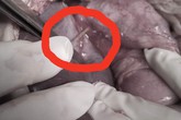 Que tăm nhọn hoắt đâm xuyên dạ dày, gan, màng tim nam thanh niên Que tăm nhọn hoắt đâm xuyên dạ dày, gan, màng tim nam thanh niên