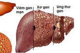 25.000 người chết vì ung thư gan mỗi năm, cách nào phát hiện sớm? 25.000 người chết vì ung thư gan mỗi năm, cách nào phát hiện sớm?