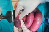 Thường xuyên uống trà sữa thay cơm, chàng trai trẻ tắc ruột vì bã thức ăn to đùng Thường xuyên uống trà sữa thay cơm, chàng trai trẻ tắc ruột vì bã thức ăn to đùng