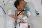 Bé trai sinh non 1,6kg bị teo ruột bẩm sinh được gây mê, phẫu thuật thành công Bé trai sinh non 1,6kg bị teo ruột bẩm sinh được gây mê, phẫu thuật thành công