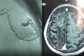 Người đàn ông đau đầu 30 năm, bác sĩ lôi ra sinh vật 10cm trong não Người đàn ông đau đầu 30 năm, bác sĩ lôi ra sinh vật 10cm trong não
