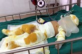 Thương tâm bé trai 7 tháng tuổi cùng cha mẹ bị bỏng nặng do hở gas lúc đun nấu Thương tâm bé trai 7 tháng tuổi cùng cha mẹ bị bỏng nặng do hở gas lúc đun nấu