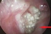 Người đàn ông bị sùi mào gà vì thường xuyên đi lấy ráy tai: Cảnh báo những thói quen tai hại dễ rước bệnh vào người Người đàn ông bị sùi mào gà vì thường xuyên đi lấy ráy tai: Cảnh báo những thói quen tai hại dễ rước bệnh vào người