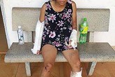 Bình Thuận: Vợ bị chồng đánh gãy 2 tay 1 chân Bình Thuận: Vợ bị chồng đánh gãy 2 tay 1 chân
