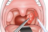 Cảnh báo những rủi ro có thể gặp phải khi cắt amidan Cảnh báo những rủi ro có thể gặp phải khi cắt amidan