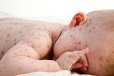Vì sao cốm Subạc được coi là “cứu tinh” cho người mắc bệnh ngoài da do virus? Vì sao cốm Subạc được coi là “cứu tinh” cho người mắc bệnh ngoài da do virus?