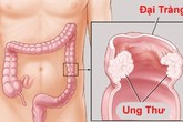 Bác sĩ cảnh báo: Bị đau bụng âm ỉ, có thể bạn đã bị ung thư nhưng không hề biết Bác sĩ cảnh báo: Bị đau bụng âm ỉ, có thể bạn đã bị ung thư nhưng không hề biết