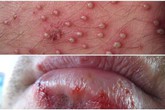 Các bệnh ngoài da do virus là gì và cách điều trị hiệu quả như thế nào? Các bệnh ngoài da do virus là gì và cách điều trị hiệu quả như thế nào?