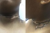 Chỉ vì thói quen này khi đi ngủ mà người phụ nữ bị bỏng cổ nghiêm trọng, ai mắc phải cần tránh ngay Chỉ vì thói quen này khi đi ngủ mà người phụ nữ bị bỏng cổ nghiêm trọng, ai mắc phải cần tránh ngay