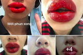 Cô gái ở Hà Nội bị sưng tều môi, nổi mụn nước sau khi làm ở spa gần nhà Cô gái ở Hà Nội bị sưng tều môi, nổi mụn nước sau khi làm ở spa gần nhà
