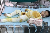 Xót xa bé trai 2 tuổi bị bỏng toàn thân do ngã vào nồi nước nóng Xót xa bé trai 2 tuổi bị bỏng toàn thân do ngã vào nồi nước nóng