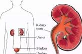 Người mẹ đang cho con bú phải cắt thận trái, thủ phạm là thói quen nhiều người mắc Người mẹ đang cho con bú phải cắt thận trái, thủ phạm là thói quen nhiều người mắc