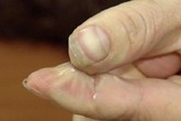 Lỡ bị keo 502 dính vào tay bạn đừng vội kéo ra mà rách da, đây là cách khiến keo bong cực nhanh mà lại không đau Lỡ bị keo 502 dính vào tay bạn đừng vội kéo ra mà rách da, đây là cách khiến keo bong cực nhanh mà lại không đau