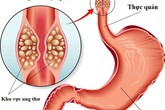 "Ngất xỉu" khi nghe BS báo tin bị mắc 2 bệnh ung thư cùng lúc: Ân hận vì 3 thói quen xấu "Ngất xỉu" khi nghe BS báo tin bị mắc 2 bệnh ung thư cùng lúc: Ân hận vì 3 thói quen xấu