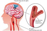 Sai lầm nhiều người mắc khi sơ cứu người bị đột quỵ khiến bệnh trầm trọng hơn Sai lầm nhiều người mắc khi sơ cứu người bị đột quỵ khiến bệnh trầm trọng hơn