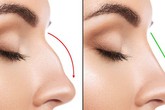 Tiêm chất làm đầy để nâng mũi, vừa kết thúc thủ thuật cô gái 19 tuổi lập tức bị mù 1 bên mắt Tiêm chất làm đầy để nâng mũi, vừa kết thúc thủ thuật cô gái 19 tuổi lập tức bị mù 1 bên mắt