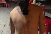 Xôn xao hình ảnh cháu bé bị đánh đập bầm dập khắp người Xôn xao hình ảnh cháu bé bị đánh đập bầm dập khắp người