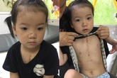 Không có tiền phẫu thuật tim, bé gái 4 tuổi có nguy cơ mất đi sự sống Không có tiền phẫu thuật tim, bé gái 4 tuổi có nguy cơ mất đi sự sống