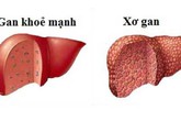 Bệnh xơ gan cần kiêng gì? Bệnh xơ gan cần kiêng gì?