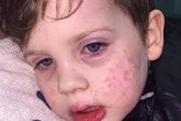 Bé trai 3 tuổi nhiễm virus bệnh tình dục sau nụ hôn vào má Bé trai 3 tuổi nhiễm virus bệnh tình dục sau nụ hôn vào má