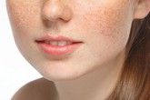 Nám da do rối loạn nội tiết Nám da do rối loạn nội tiết