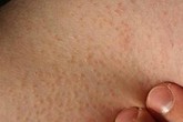 Phòng bệnh viêm nang lông Phòng bệnh viêm nang lông