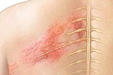 Nguyên nhân đau sau khi zona thần kinh đã lành Nguyên nhân đau sau khi zona thần kinh đã lành