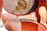 Trả giá đắt: Suýt viêm màng não vì cái bông tăm Trả giá đắt: Suýt viêm màng não vì cái bông tăm