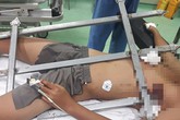 Trèo cây ngã xuống, cậu bé 13 tuổi bị chông hàng rào đâm xuyên dọc ngực Trèo cây ngã xuống, cậu bé 13 tuổi bị chông hàng rào đâm xuyên dọc ngực