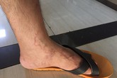 “Sởn da gà” nhìn ấu trùng đào hầm dưới da, BS cảnh báo những người nguy cơ cao mắc bệnh “Sởn da gà” nhìn ấu trùng đào hầm dưới da, BS cảnh báo những người nguy cơ cao mắc bệnh