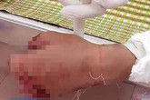 Thanh niên Quảng Trị nát bàn tay vì dùng điện thoại khi đang sạc Thanh niên Quảng Trị nát bàn tay vì dùng điện thoại khi đang sạc