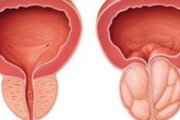 Nam giới xuất hiện 4 dấu hiệu này, có thể là tuyến tiền liệt đang "kêu cứu" Nam giới xuất hiện 4 dấu hiệu này, có thể là tuyến tiền liệt đang "kêu cứu"