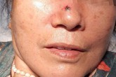 Nốt ruồi trên sống mũi bỗng "hoá" thành ung thư: Cách phân biệt nốt ruồi và ung thư Nốt ruồi trên sống mũi bỗng "hoá" thành ung thư: Cách phân biệt nốt ruồi và ung thư