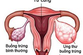 Nhiều trẻ chưa 15 tuổi đã mắc ung thư buồng trứng, đừng chủ quan khi thấy dấu hiệu này Nhiều trẻ chưa 15 tuổi đã mắc ung thư buồng trứng, đừng chủ quan khi thấy dấu hiệu này
