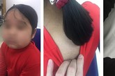 Con gái mập ra, mọc nhiều lông mẹ tưởng dậy thì, đi khám BS chỉ nguyên nhân do xịt mũi Con gái mập ra, mọc nhiều lông mẹ tưởng dậy thì, đi khám BS chỉ nguyên nhân do xịt mũi