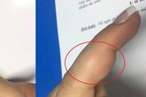 Bị sưng đau ngón tay, người phụ nữ không ngờ mang khối u ở vị trí cực hiếm gặp Bị sưng đau ngón tay, người phụ nữ không ngờ mang khối u ở vị trí cực hiếm gặp