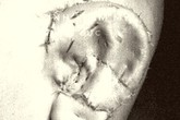 Phẫu thuật thành công kỹ thuật tạo hình tai nhỏ microtia tiên tiến nhất thế giới Phẫu thuật thành công kỹ thuật tạo hình tai nhỏ microtia tiên tiến nhất thế giới