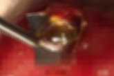 Lại một ca thủng ruột vì uống thuốc còn nguyên vỏ Lại một ca thủng ruột vì uống thuốc còn nguyên vỏ