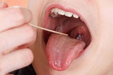 Ung thư lưỡi ngày càng phổ biến, bác sĩ cảnh báo 4 nguyên nhân gây bệnh Ung thư lưỡi ngày càng phổ biến, bác sĩ cảnh báo 4 nguyên nhân gây bệnh