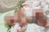 Xét nghiệm gene bé sơ sinh mắc bệnh da vảy cá hiếm gặp Xét nghiệm gene bé sơ sinh mắc bệnh da vảy cá hiếm gặp