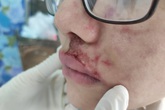 TPHCM: Cô gái trẻ sưng phù mặt khi tiêm filler làm đẹp TPHCM: Cô gái trẻ sưng phù mặt khi tiêm filler làm đẹp