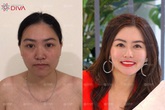 Ghép mỡ mặt tự thân – tạo dáng khuôn mặt chuẩn tỷ lệ vàng không phẫu thuật Ghép mỡ mặt tự thân – tạo dáng khuôn mặt chuẩn tỷ lệ vàng không phẫu thuật