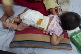 Trẻ nghỉ học ở nhà, cẩn trọng tai nạn bỏng Trẻ nghỉ học ở nhà, cẩn trọng tai nạn bỏng