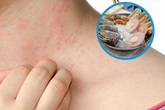 Ham hải sản giá rẻ, nguy kịch vì dị ứng Ham hải sản giá rẻ, nguy kịch vì dị ứng