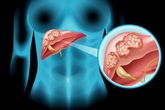 Cách phát hiện sớm và phòng bệnh ung thư gan Cách phát hiện sớm và phòng bệnh ung thư gan
